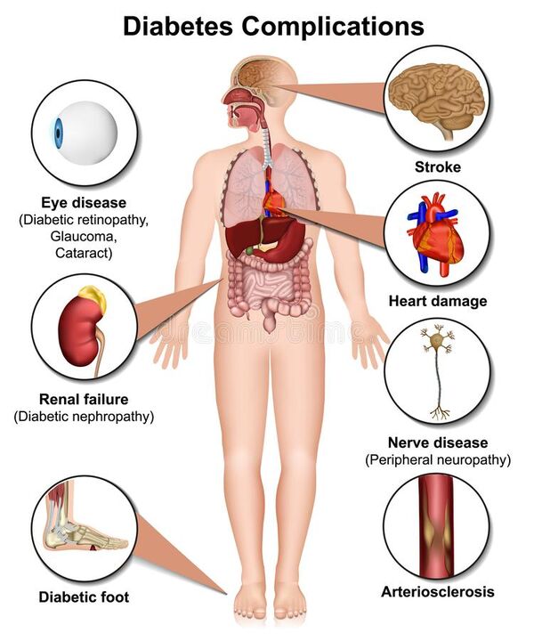 As a result of diabetes